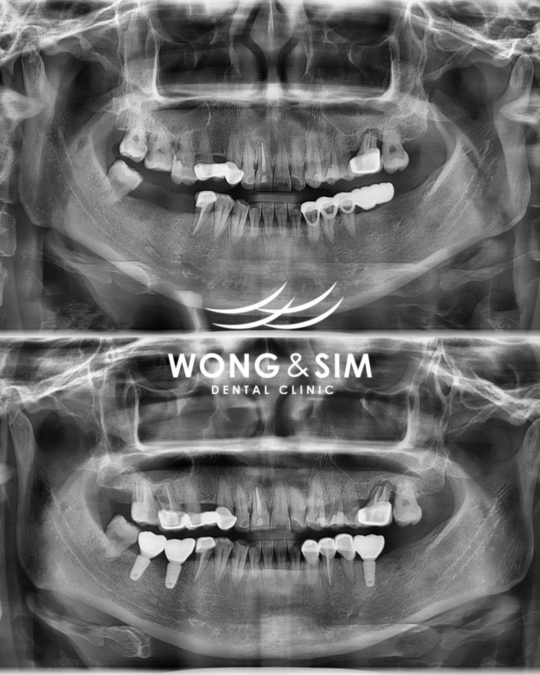 Implant Patient 3
