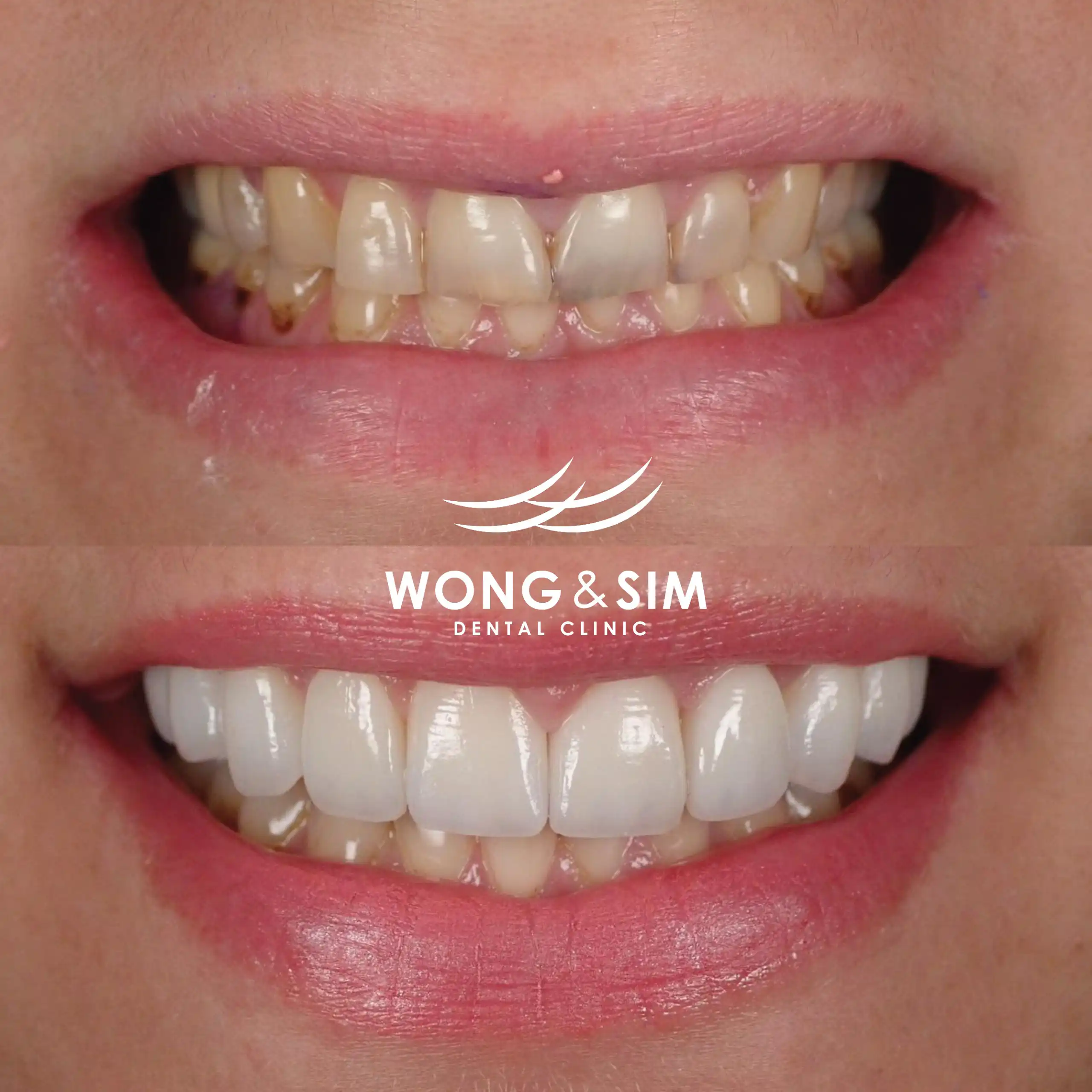 Before and after image of patient 2's teeth after dental treatment.