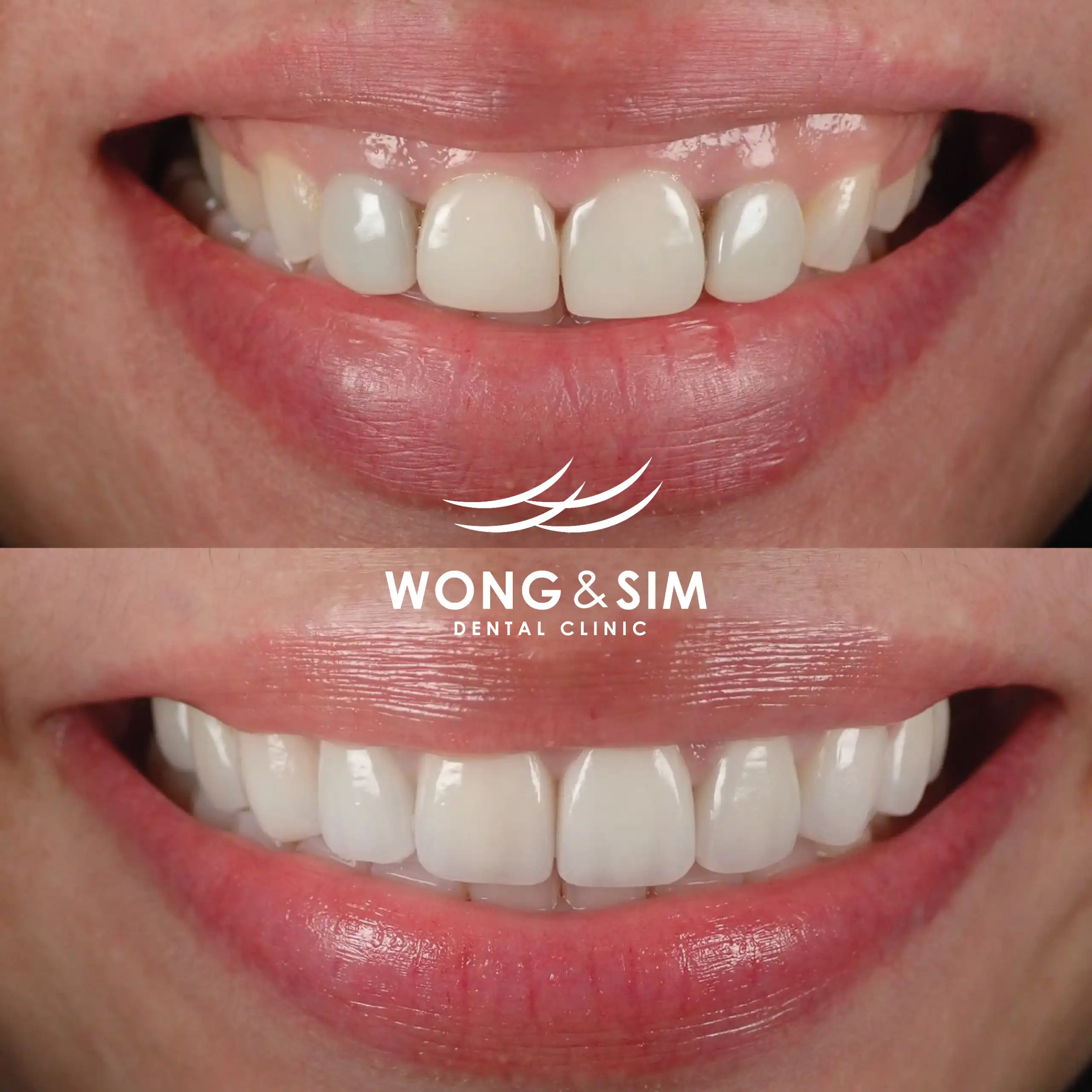 Before and after image of patient 4's teeth after dental treatment.