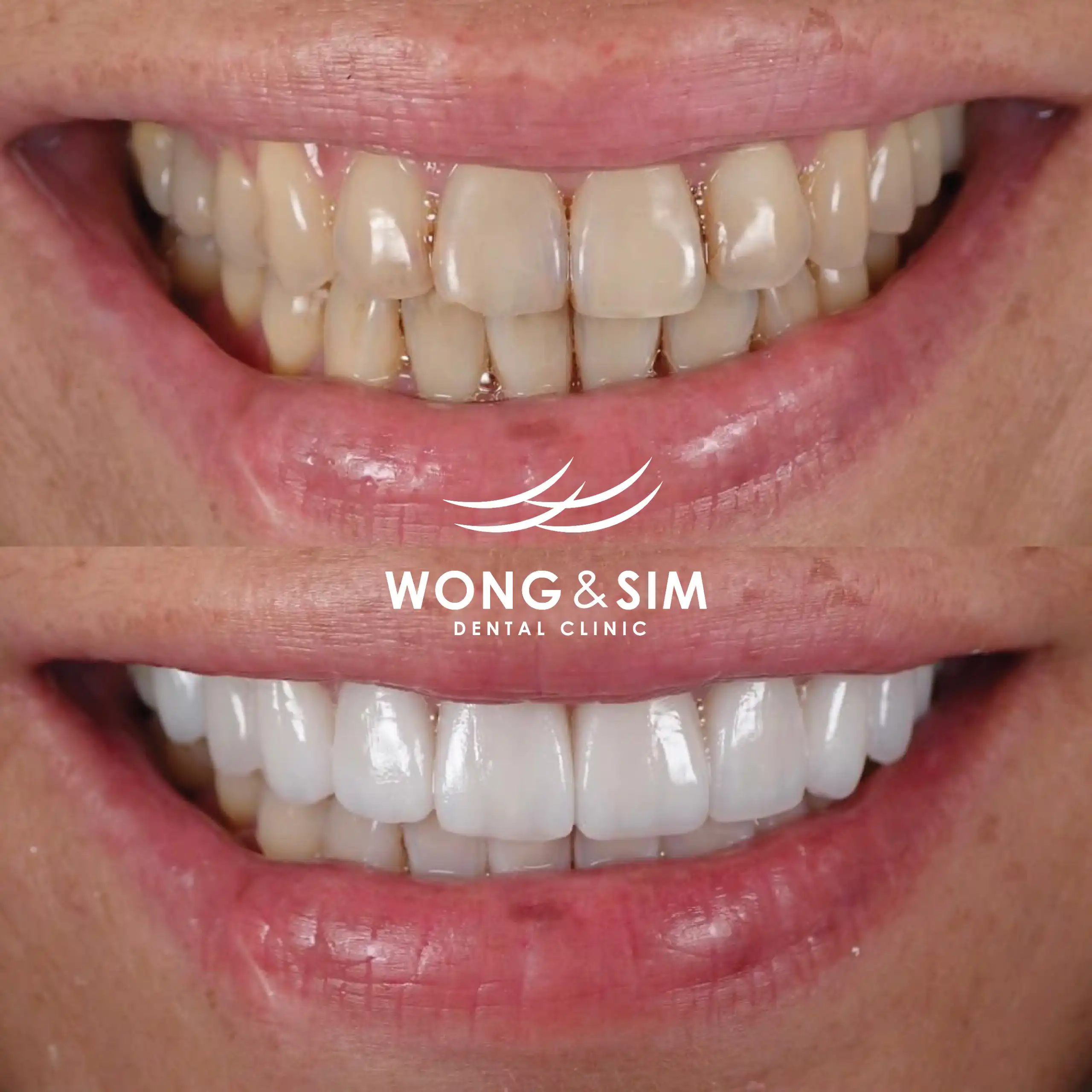 Before and after image of patient 6's teeth after dental treatment.