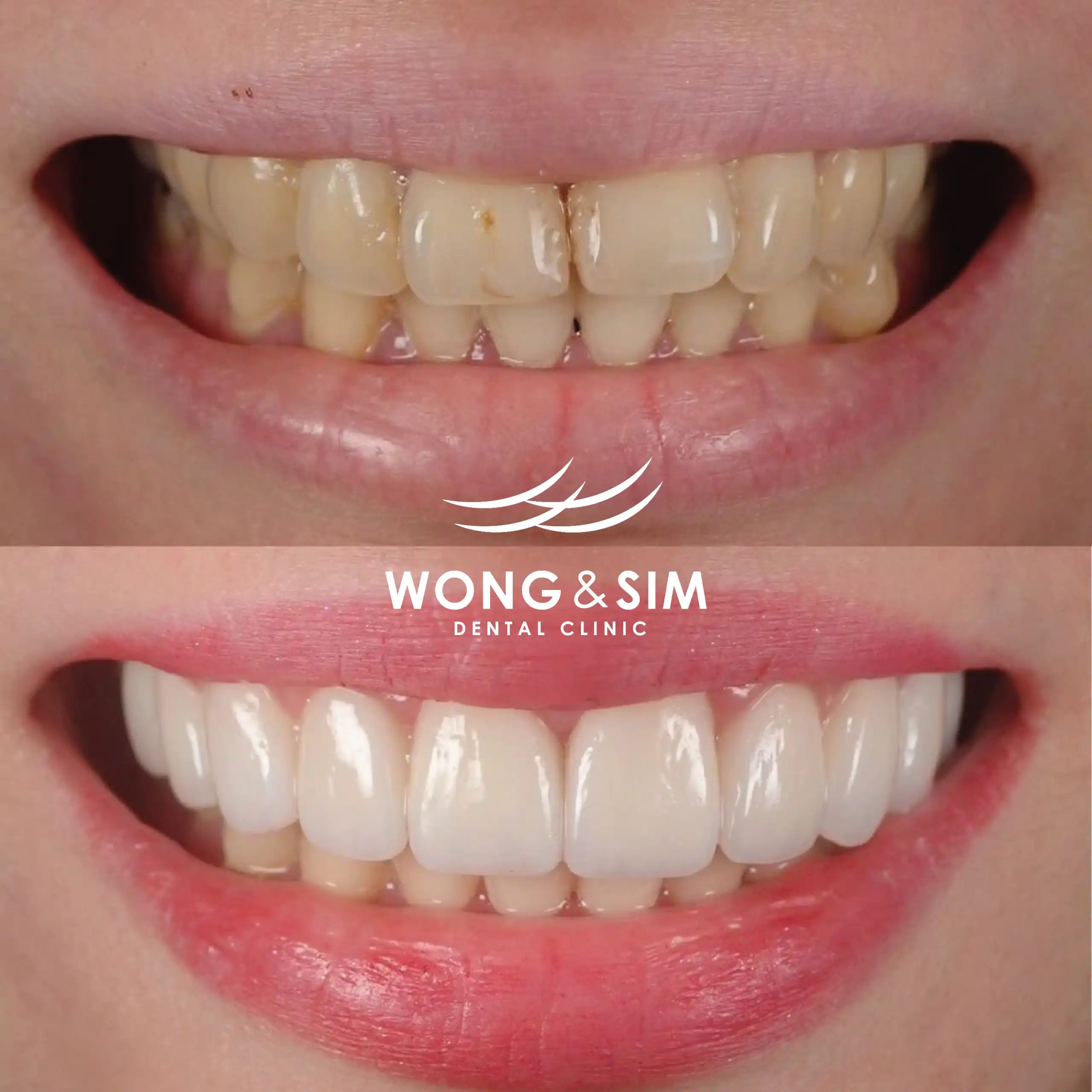 Before and after image of patient 8's teeth after dental treatment.