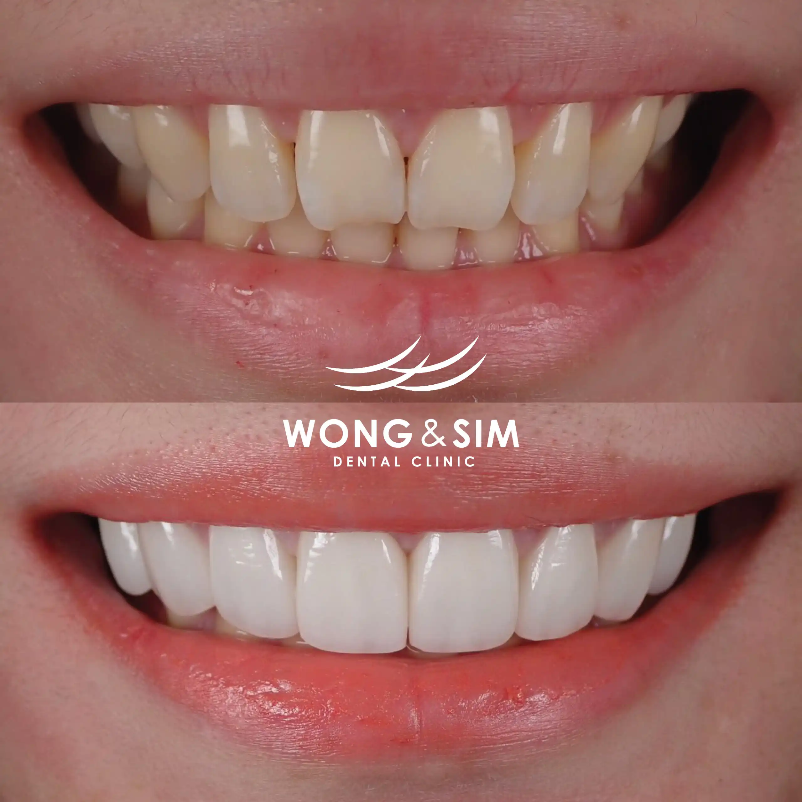 Before and after image of patient 9's teeth after dental treatment.